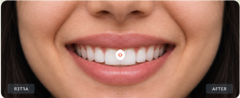 Clear Aligners vs Traditional Braces
